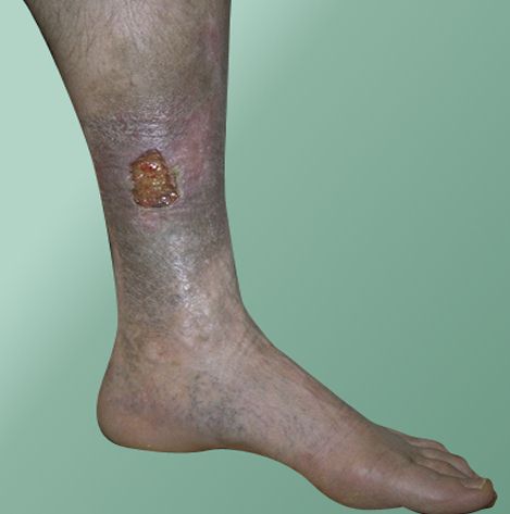 Venous leg ulcers usually appear on the inside of the lower leg.
