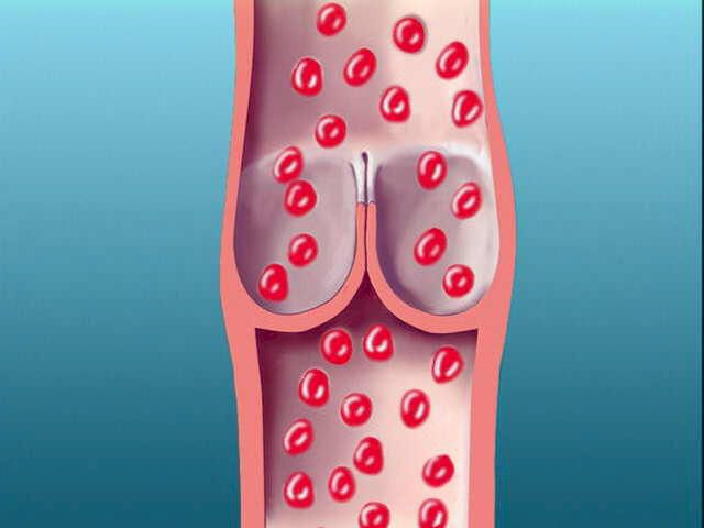 A one-way valve inside a leg vein.  