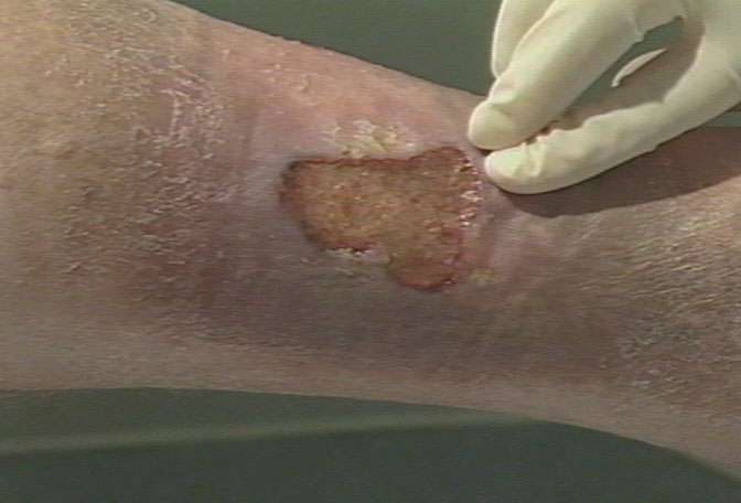 This venous leg ulcer is being cleaned and examined.