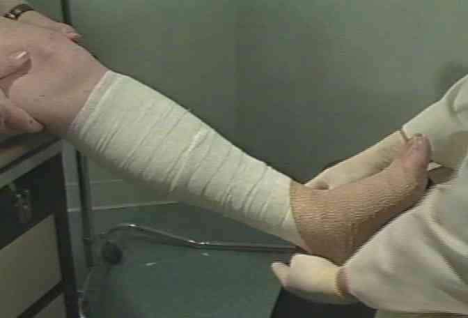 This compression bandage helps blood flow up and out of the legs.